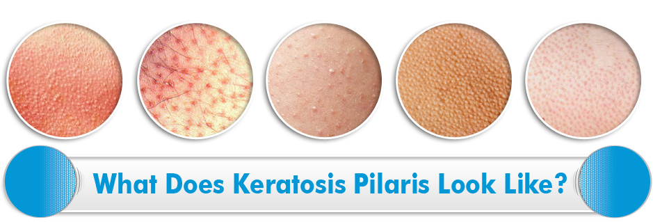 what-is-keratosis-pilaris-kpessentials